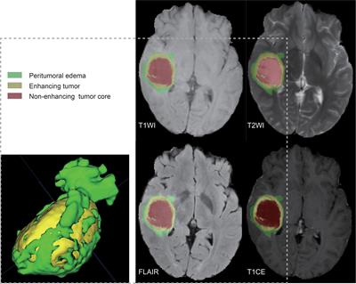 Multiparametric magnetic resonance imaging-derived deep learning network to determine ferroptosis-related gene signatures in gliomas
